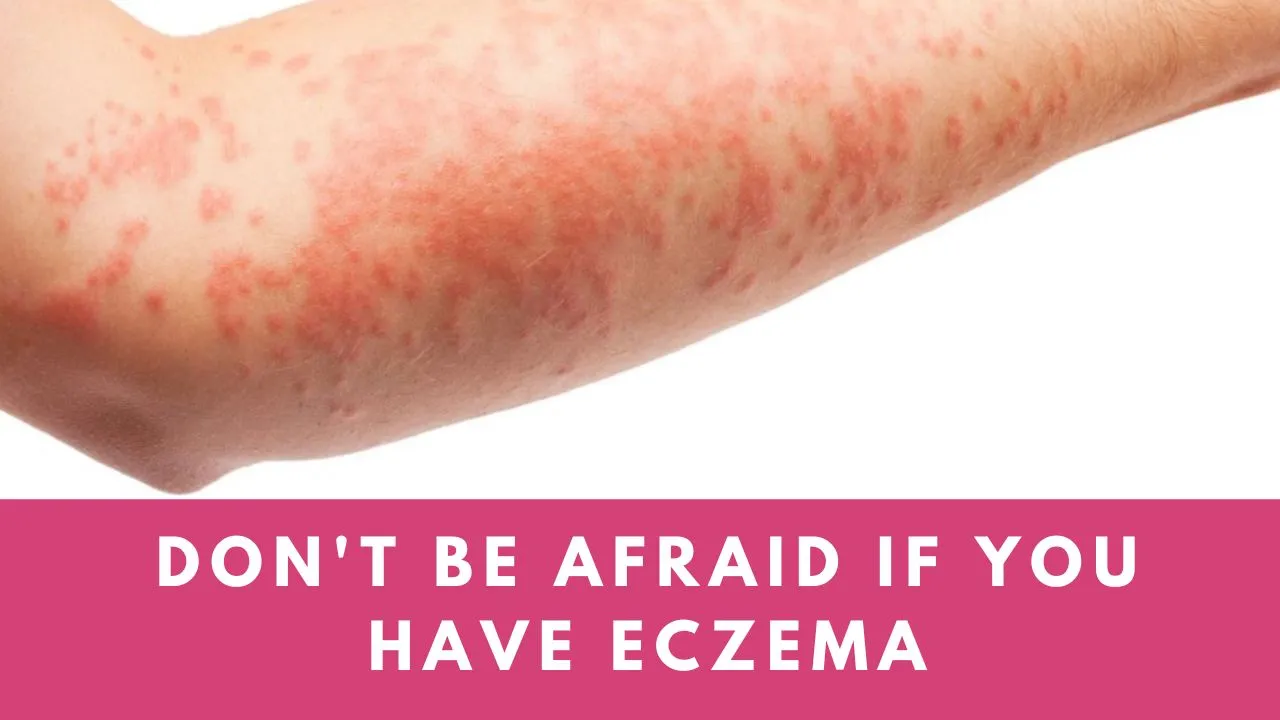 Don't be afraid if you have eczema.