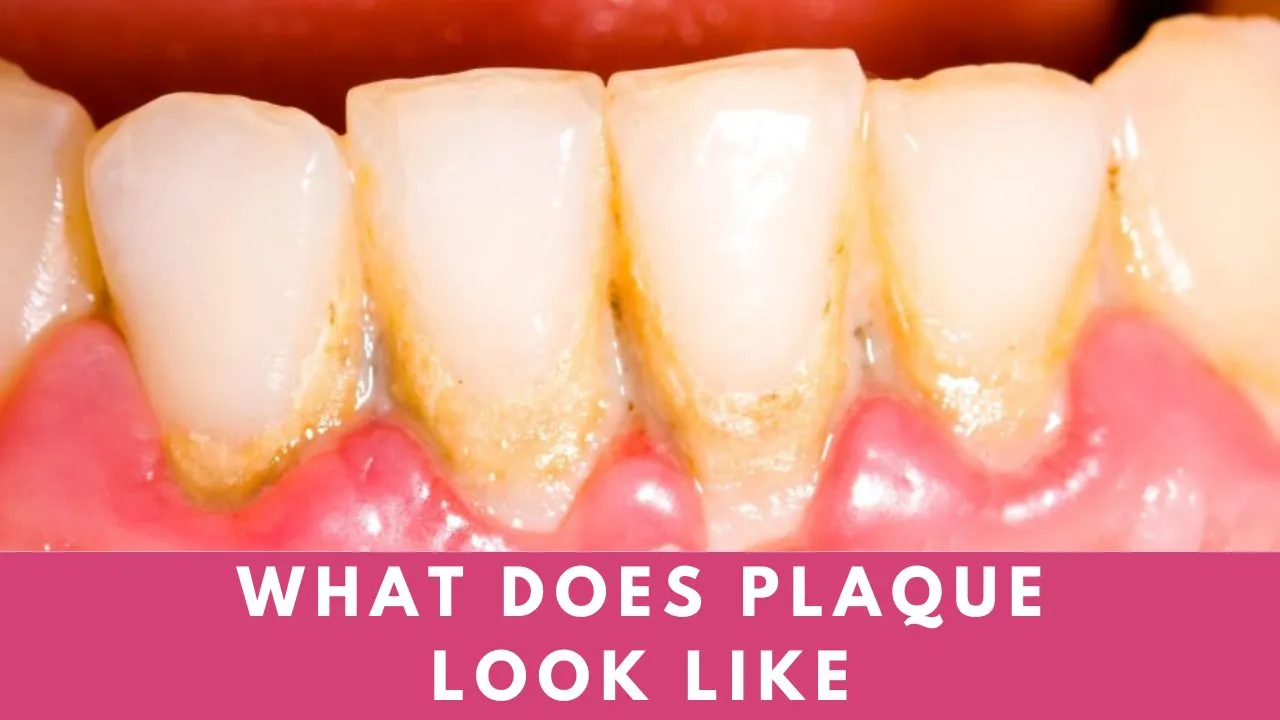 What does plaque look like?  How do you remove plaque?